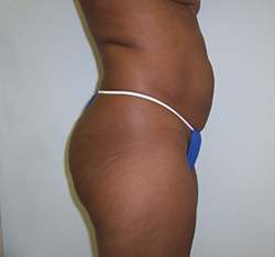 Before Brazilian Butt Lift