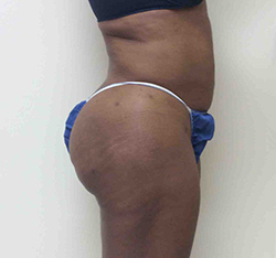 After Brazilian Butt Lift