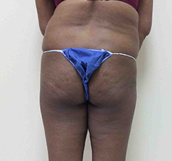 Before Brazilian Butt Lift