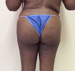After Brazilian Butt Lift