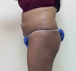 Before Brazilian Butt Lift