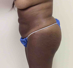 After Brazilian Butt Lift