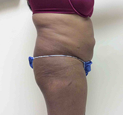 Before Brazilian Butt Lift