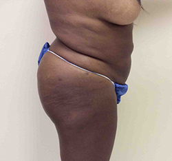 After Brazilian Butt Lift