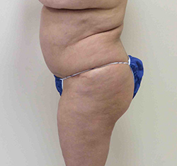 Before Brazilian Butt Lift