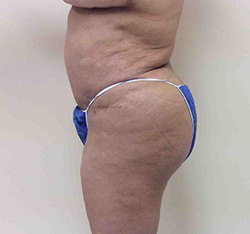 After Brazilian Butt Lift