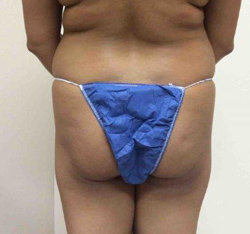 Before Brazilian Butt Lift