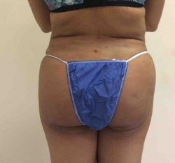 After Brazilian Butt Lift