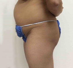 Before Brazilian Butt Lift