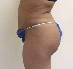 After Brazilian Butt Lift