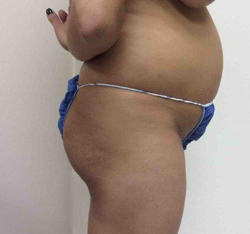 Before Brazilian Butt Lift