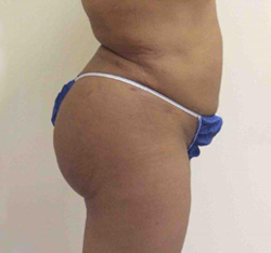 After Brazilian Butt Lift