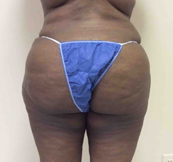 After Brazilian Butt Lift
