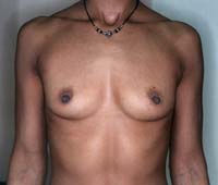 Before Breast Augmentation