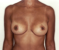 After Breast Augmentation