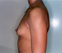 Before Breast Augmentation