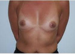 Before Breast Augmentation
