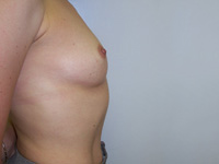 Before Breast Augmentation
