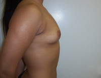 Before Breast Augmentation