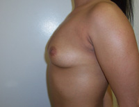 Before Breast Augmentation