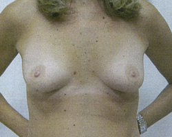 Before Breast Augmentation