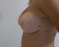 After Breast Augmentation