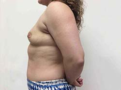 Before Breast Augmentation