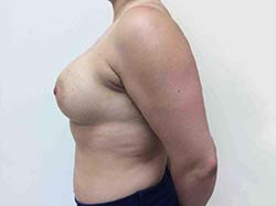After Breast Augmentation