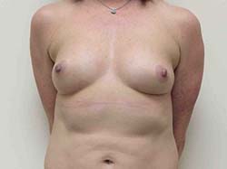 Before Breast Augmentation