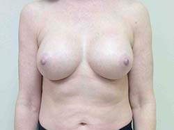 After Breast Augmentation