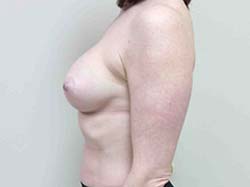 After Breast Augmentation
