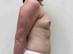 Before Breast Augmentation