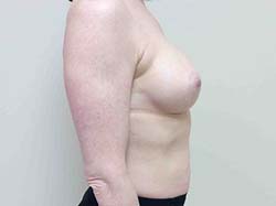 After Breast Augmentation