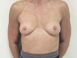 Before Breast Augmentation