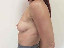 Before Breast Augmentation