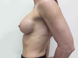After Breast Augmentation
