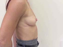Before Breast Augmentation