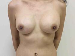 After Breast Augmentation