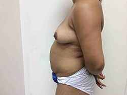 Before Breast Augmentation