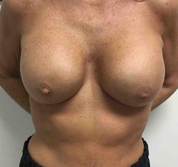 Before Breast Implant Exchange
