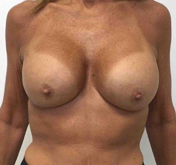 After Breast Implant Exchange