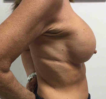 Before Breast Implant Exchange