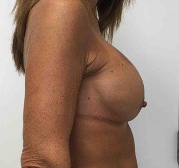 After Breast Implant Exchange