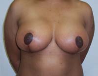 After Breast Lift