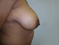 Before Breast Lift