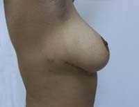 After Breast Lift