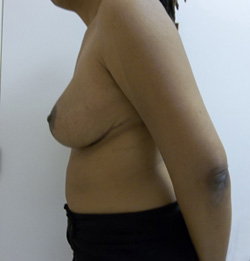 After Breast Lift