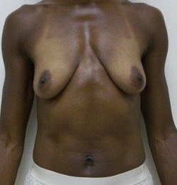 Before Breast Lift