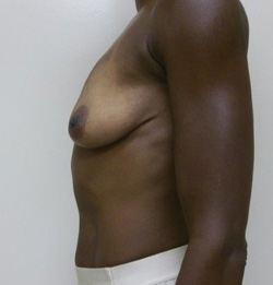 Before Breast Lift