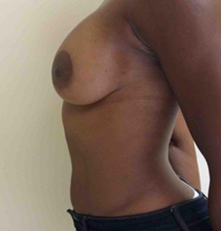 After Breast Lift